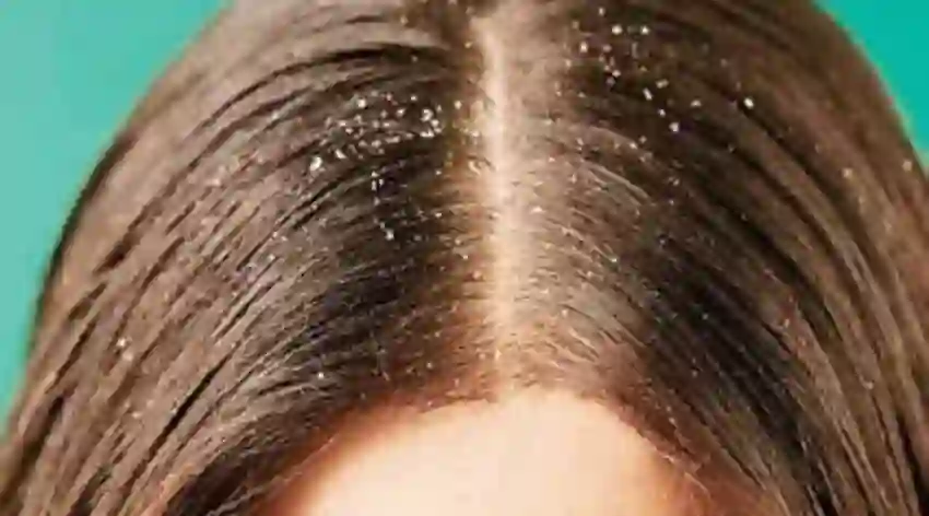 Haircare tips of सर्दियों में डैंड्रफ से हैं परेशान, तो आजमाएं ये घरेलू नुस्खे; रूसी से मिल सकता है छुटकारा